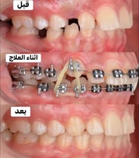 تقويم أسنان • مجانا • جامعة كربلاء