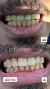 🦷✨ نتيجة تنظيف الأسنان… فرق واضح من أول جلسة! ✨🦷 تنظيف الأسنان الاحترا...
