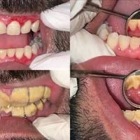 تنظيف اسنان • تبييض اسنان • بعقوبة جامعة بلاد الرافدين