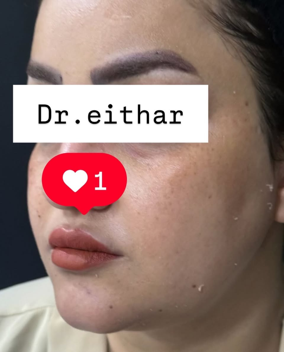 كونتور الوجه بالفلر  (لفتنك وجنات  واصداغ وتدوير الفك والذقن ونظاره وشفة قبل ٣ سنين حاقنتهه الهه مجددناه  ) 🔥🔥
لاحضو الفرق بالذقن ومنطقه الفك والوجنات شكد تغير الشكل🔥
عروووض للكادر التدريسي والخريجات والموظفات والعروسات  ثبتتهه الكم بالستوري بالهايلايت وببوست اعلى الصفحة ✨✨

د.ايثار سامي عبد الامير
واسط الكوت الهوره مجمع القبطان طابق اول 

الحجز***********
