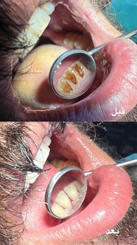 علاج مجاني • حشوات تجميلية • الكرادة شارع 52