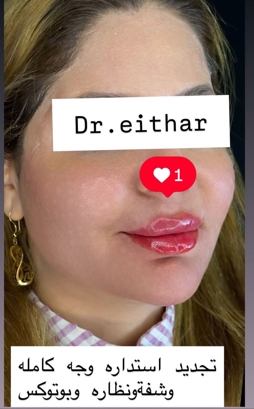 كونتور الوجه  (لفتنك وجنات  واصداغ وتدوير الفك والذقن ونظاره وشفة ونظاره وبوتوكس بعد الحقن باسبوعين ) 🔥🔥🔥

اتمددت عروووض للكادر التدريسي والخريجات والموظفات والعروسات لنهايه الاسبوع ليوم الاربعاء اخر يوم  ثبتتهه الكم بالستوري بالهايلايت وببوست اعلى الصفحة ✨✨

د.ايثار سامي عبد الامير
واسط الكوت الهوره مجمع القبطان طابق اول 

الحجز***********

نص مكتوب في الصور:
- Dr.eithar 1 تجديد لفتنك وجنات واصداغ وتدوير الفك والذقن وشغة ونظاره وبوتوكس
- Dr.eithar
- 1
- تجديد استداره وجه كامله
- وشفه ونظاره وبوتوكس
- Dr.eithar 1 بعد حقن استداره وجه كامله بطريقة كونتور وشد . وشفه ونظاره وبوتوكس بعد االحقن باسبوعين
- Dr.eithar 1 قبل التجديد
- قبل الحقن والصور الي بعد هي بعدالحقن باسبوعين