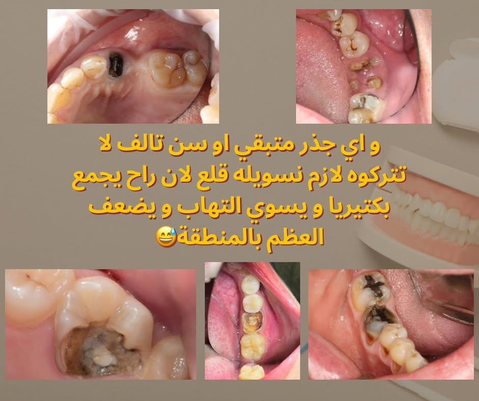 السلام علیکم
اي احد عنده تسوس او تصبغات او تكلسات او جذر متبقي او سن تالف او اسنان
بفقودة يريد يعوضهن يتواصل ويانا

[***********](tel:***********)
تليجرام 👈 Ayaa3_14@ 

موقعنا: جامعة الكوفة - قرب كلية الفقه

نص مكتوب في الصور:
- شكل اسنانكم ما عاجبكم و تريدون تسوولهن تنظيف مجاني؟ تعالوا لعيادات جامعة الكوفة
- و اذا عندكم ام او اب او اي شخص كبير بالسن و عدهم اسنان مفقودة شجعوهم حتى يسوون طقم متحرك هم سعره جدا رمزي و هم يحافظ على باقي الاسنان و هم يعوضهم اسنانهم المفقودة🥺💕
- BEFORE
- AFTER
- لا تتركو التسوس يوصل مرحلة منكدر نعالجة الا بحشوة جذر! ف عالجوه بحشوة ضوئية 👀✨
- و اي جذر متبقي او سن تالف لا تتركوه لازم نسويله قلع لان راح يجمع بكتيريا و يسوي التهاب و يضعف العظم بالمنطقة 😅
- و غيرها من الحالات اللي نعاجلها بعياداتنا ✨️🫶✨️ حافظوا على ابتساماتكم الحلوة.. خصوصا انو نقدم لكم بعياداتنا بجامعة الكوفة علاج مجاني و تحت اشراف دكاترة اختصاص 🫶