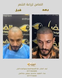 زراعة الشعر • كثافة ١٠٠% • كربلاء