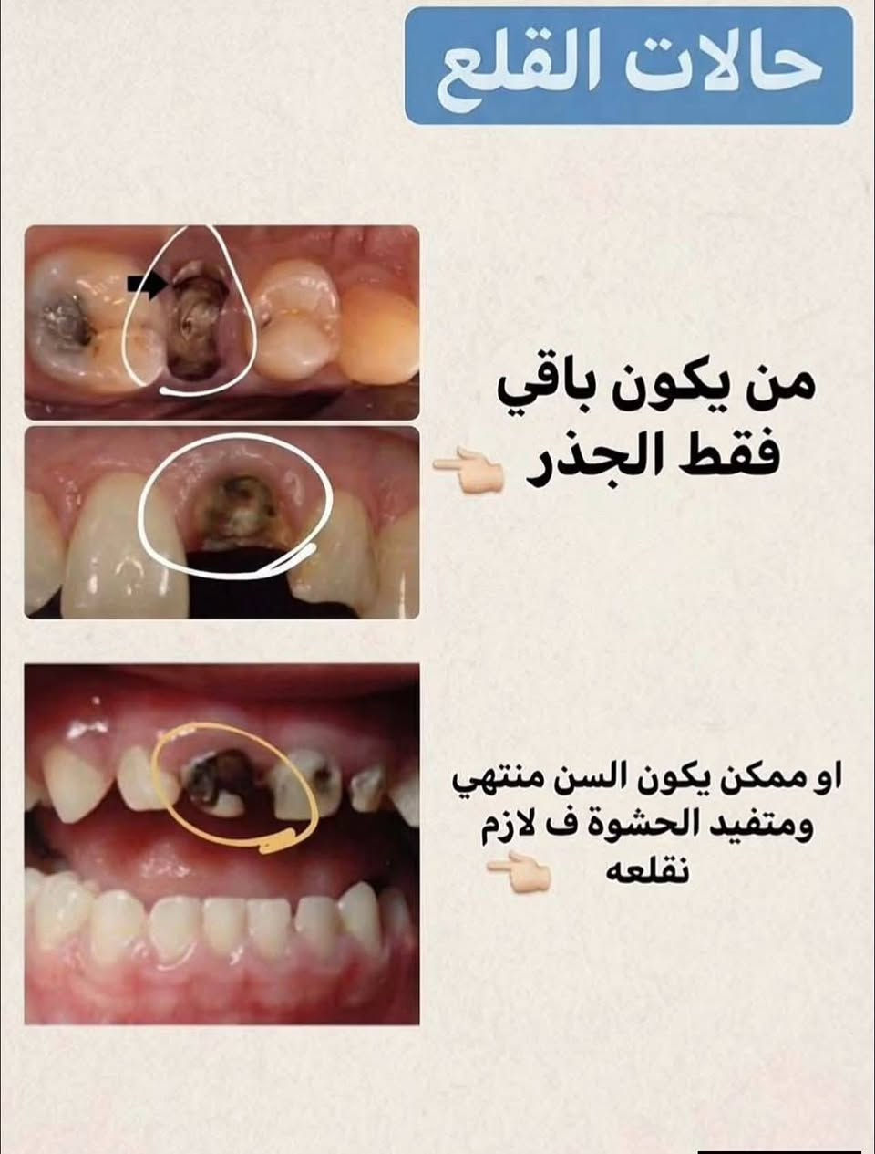 قلع اسنان • علاج مجاني • عيادات الجامعة الوطنية