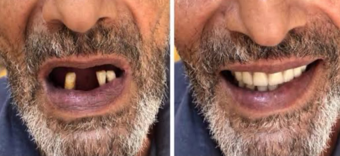 اسنان الحجي او الحجيه وكعت!؟ 
او تعرفون احد كبير بالعمر ما عندة اسنان وخطية مايكدر يأكل … 
احنة طلاب طب اسنان مرحلة اخيرة، نسويله طقم اسنان متحرك كامل (فوق وجوه)  
‼️ مجااااناً من الالف للياء.

العلاج كله علينا، والمواد علينا، بس تعال انت وابتسامتك نسويلك فحص شامل 

اذا عندك امك، ابوك، جدك، اقربائك ، صديقك ، جاركم، لا تقصر وياه.. دزلي رسالة والباقي يمنا.

💭 والعدد محدودة جداً .

***********☎️

📍ديالى -بعقوبه - شارع الرحمة- كلية اليرموك الجامعة

#طقم_اسنان #اسنان_متحركة #علاج_مجاني #طب_اسنان #خالص #ديالى #بعقوبة #طلاب_اسنان

نص مكتوب في الصور:
- قبل التركيب (خلع جميع الأسنان) بعد التركيب (طقم أسنان كامل) الطقم العلوي الطقم السفلي الطقم كامل (من الجانب) إبتسامة جديدة .. لحياة أفضل
- EDUARDO BASTOS
- Before After