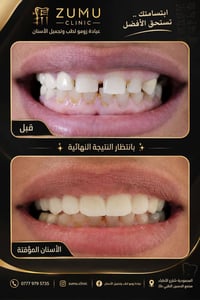 ابتسامة كاملة • تركيب مؤقت • عيادة زومو