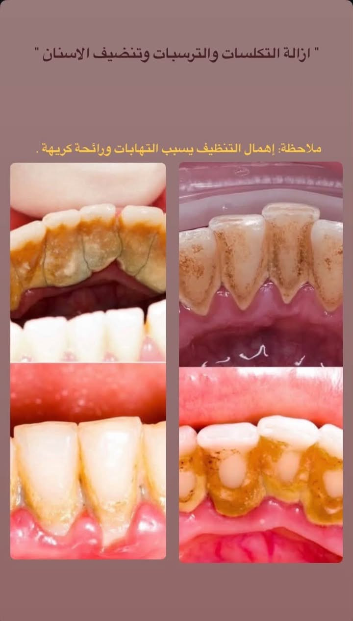 تنظيف أسنان • قلع أسنان • علاج مجاني