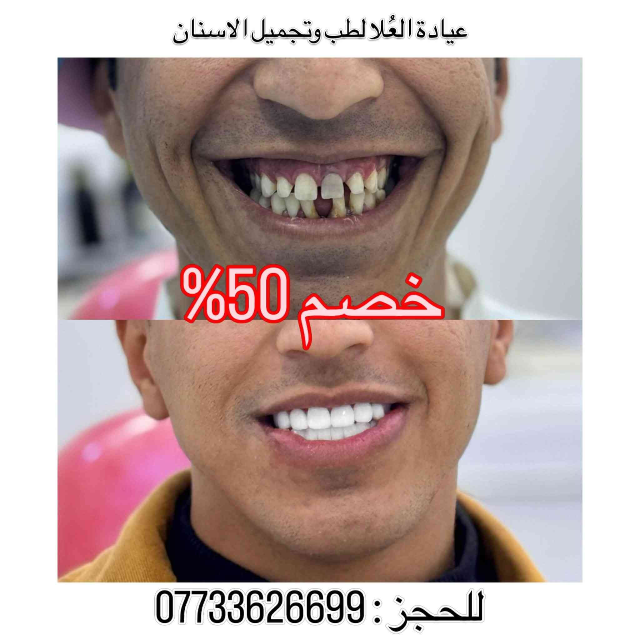 خصم ٥٠٪ • ابتسامة هوليوود • الشرطة الخامسة