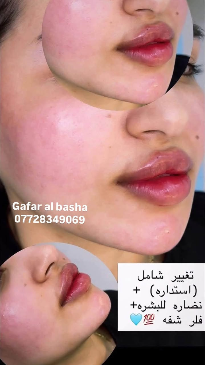عروض قسم العيادة💉🔥
لشهر 9 فقط😍
قسم الفلر : 👇🏻
🌷فلر امريكي ٧٥ الف فقط
🌷فلر كوري  ٧٥ الف
🌷فلر سوفي ديرم الماني ٨٠ الف 
🌷فلر جوفيديرم الفرنسي ٨٠ الف
🌷فلر سويسري٩٠ الف
🌹 فيلر ايطالي 100
🌸🌸🌸🌸

عرض التغيير الشامل ( شفة + وجنات + تكساس ) 350 الف فقط
Vip اب 600 الف 
🌸🌸🌸🌸

🌷ابره العروسه ١٢٥ الف بدل ال١٧٥
🌷بوتوكس كامل ١٠٠  الف بدل ال١٥٠ الف
🌷بوتوكس عدد شخصين اب١٥٠ الف
🌸🌸🌸🌸

قسم البشرة :
🌷ميزو تصبغات  50 الف
🌷ميزو هالات 50 الف
🌷هايدروفيشال  25 الف
🌷 ميزو تبييض 50 الف 
🌷علاج التصبغات البشرة 50 الف وب 75 و100 حسب النوع
🌷تنظيف البشرة + ميزو تبييض مع بلازما ٧٥ الف
🌷تنظيف البشرة الملكي ٥٠ الف الف
🌷بلازما + خلايا جذعية ٤٠ الف

 📆ايام الدوام : طيلة ايام الاسبوع
⏰وقت دوام الدكتور و الدكتورة: ‎من ١٢ مساءا  - الى ال١٠ مساءا  
📲للحجز والاستفسار 
***********💎

العنوان/ العماره مغربه

#تجميل #جمال #مكياج #تسريحات #صالون #مناكير #ميك_اب #صبغات #تساريح #ازياء #نقش #عدسات #فساتين_عرايس #حنه #ستايل #رشاقه #فاشن #عروس #موضة #لیزر #كونتور #مشغل #فساتين_سهرة #اناقه #فساتين_زفاف #0
