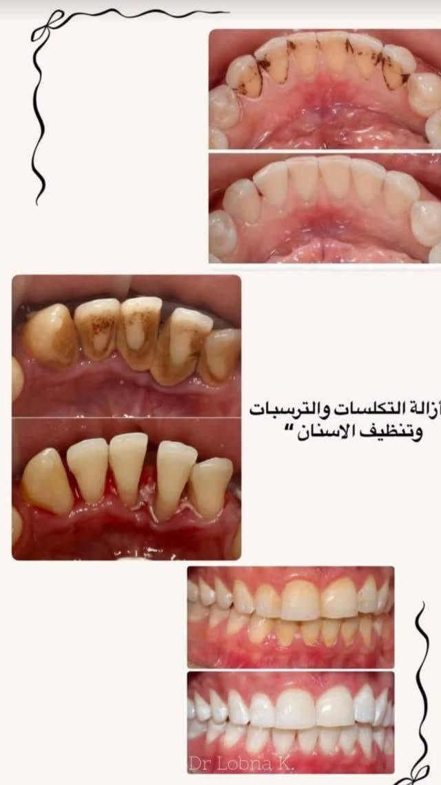 إزالة التكلسات • تنظيف الأسنان • عيادات الجامعة الوطنية