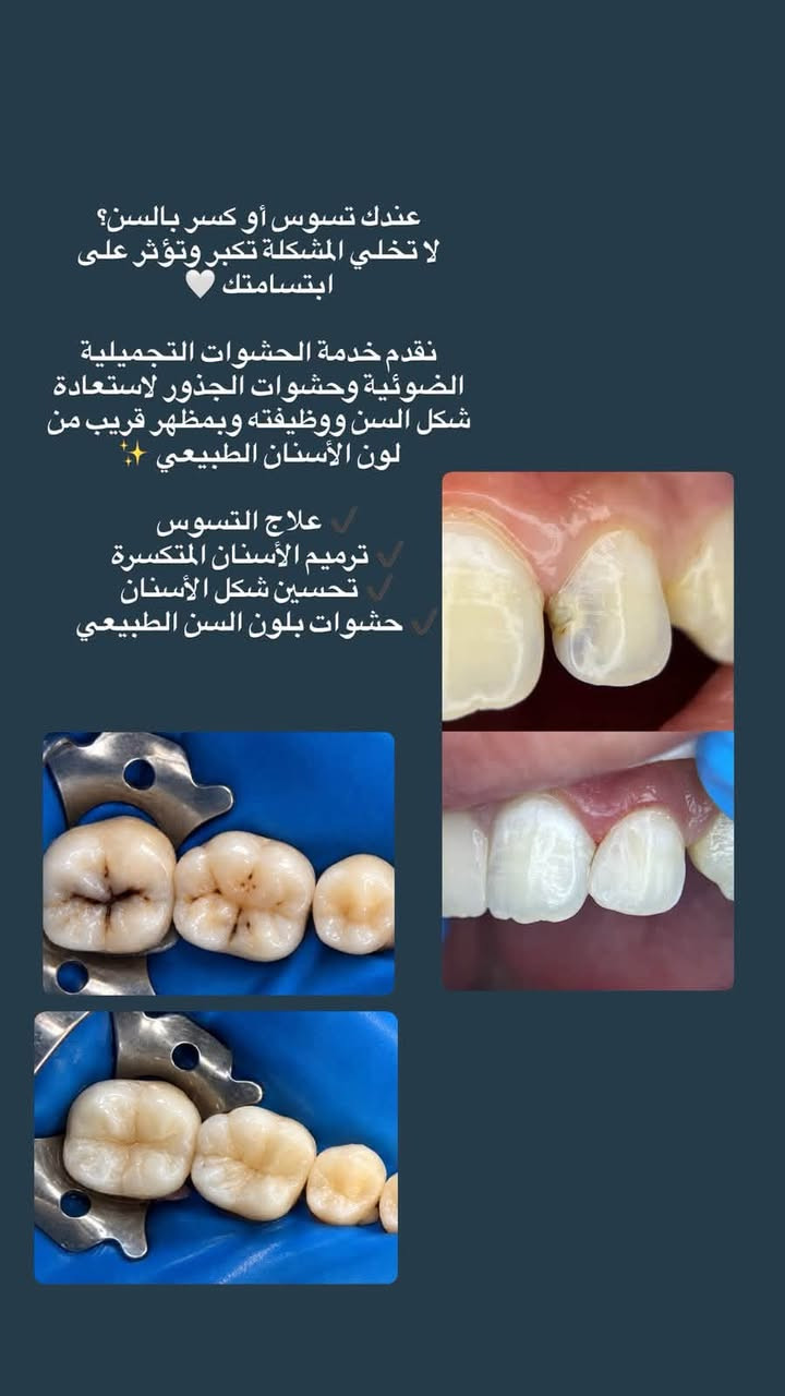 البصرة شارع التجاري • تنظيف أسنان • حشوات تجميلية