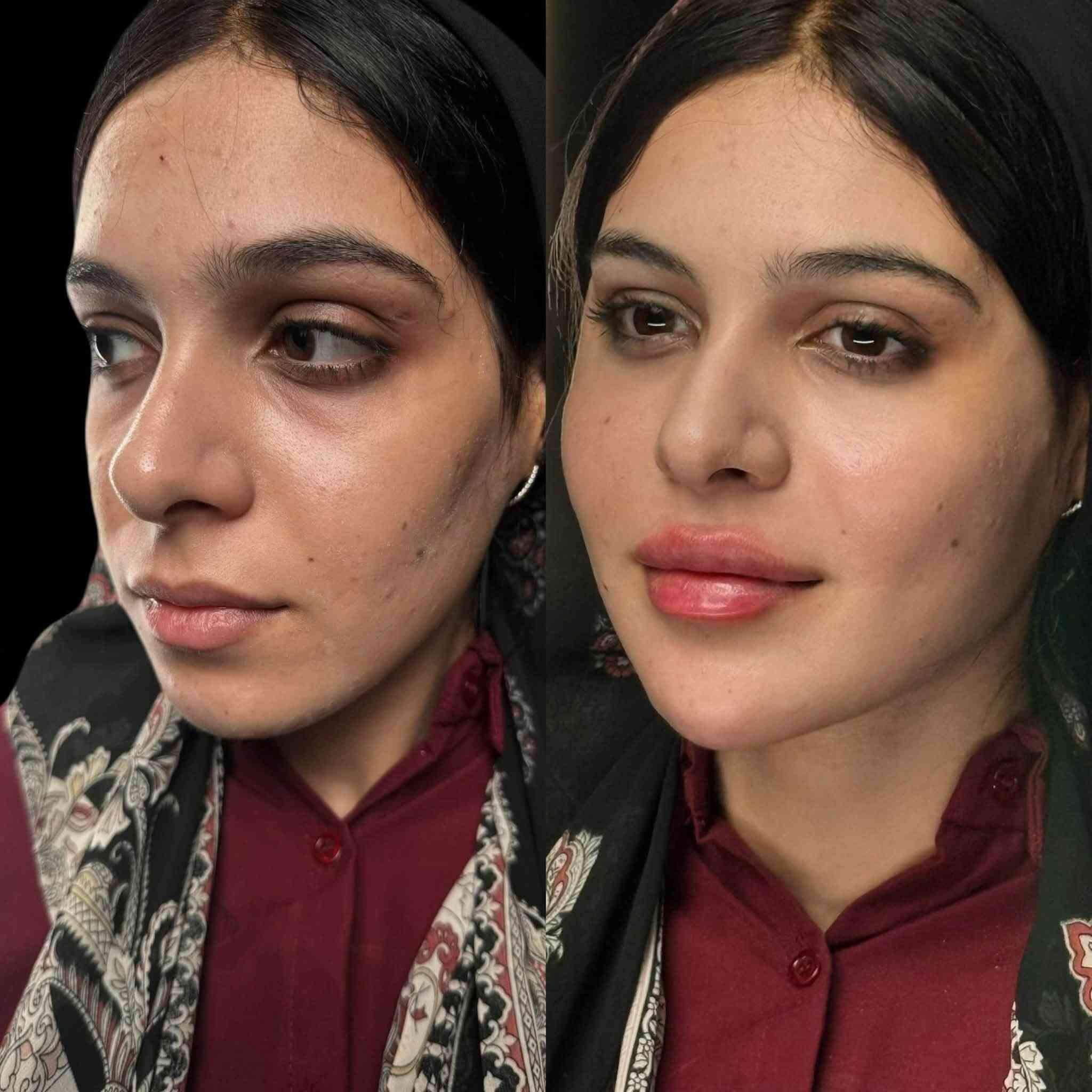 🔥👀 ركّزوا بالتغيير زين…
برأيكم شنو النقطة اللي انحقنت بالوجه وسوّت هالفرق الحلو؟ ✨💉   

لفتنك وجنات واصداغ وتدوير الفك والذقن والخطوط بطريقة شد وكونتور  وفلر شفه بالفلر السويسري تيوسيال 🔥
 
د.ايثار سامي عبد الامير 
واسط الكوت الهوره مجمع القبطان طابق اول قرب كوزمتك احمد باريس 

الحجز***********
ا
