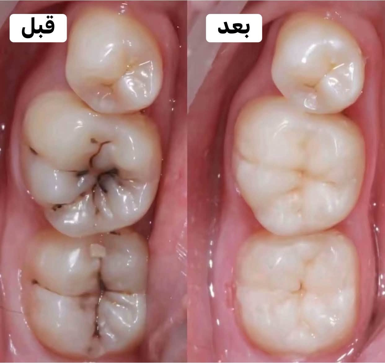 مجاني • عيادات جامعة الفارابي • حشوات/تبيض/قلع