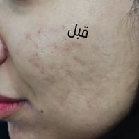 د ساره الجبوري • قبل بعد • تجميل