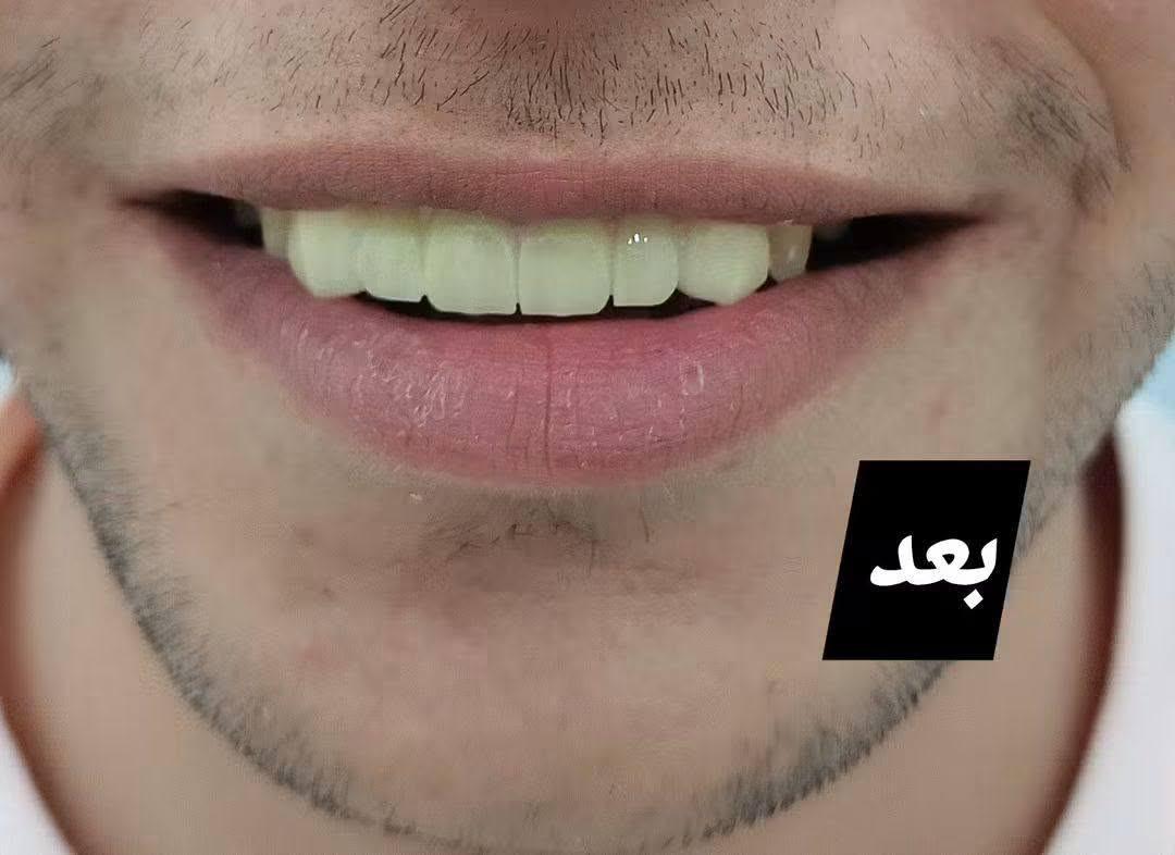 العنوان صيدلية محمود مفكر قبل المنديل مشيرفة الأولى تركيب جسر زركون أيام دوامي السبت والاثنين والاربعاء للحجز ***********

نص مكتوب في الصور:
- قبل
- بعد