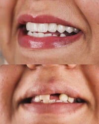 تلبيسات الأسنان • البصرة المطيحة • ابتسامة مشرقة