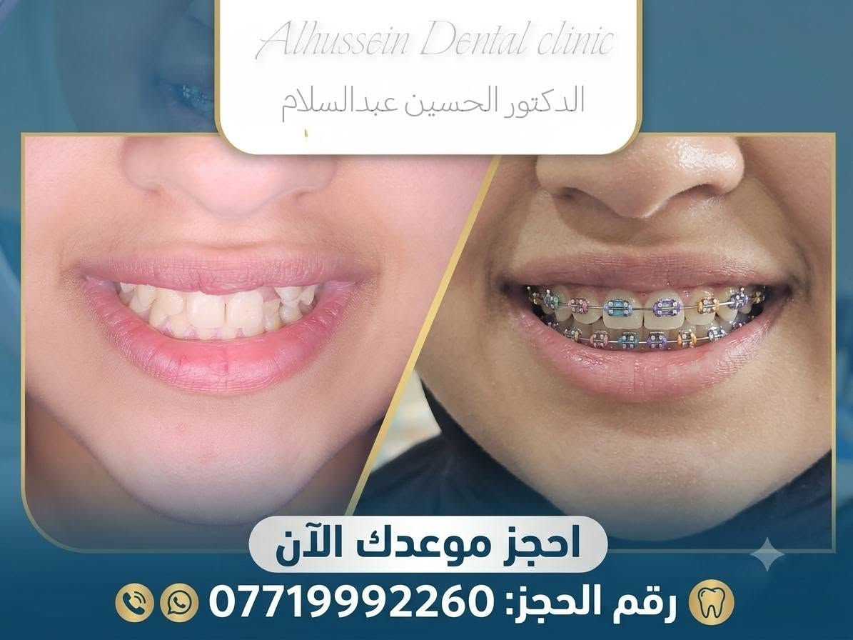 مع تقويم الأسنان في عيادة الدكتور الحسين عبد السلام، نضمن لك خطوات متقنة لابتسامة متناسقة 
اختار ألوان التقويم اللي تحبها وخلي رحلة التغيير مميزة! 🦷
📍 للحجز والاستفسار:
📞 رقم الهاتف: [***********]
📌 العنوان: [ديالى هبهب مدخل هبهب القديمة]
#طب_أسنان #تقويم_أسنان #ابتسامة_هوليوود #عيادة_أسنان #صحة_الأسنان
