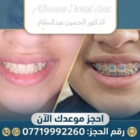 تقويم أسنان • ألوان التقويم • ديالى هبهب