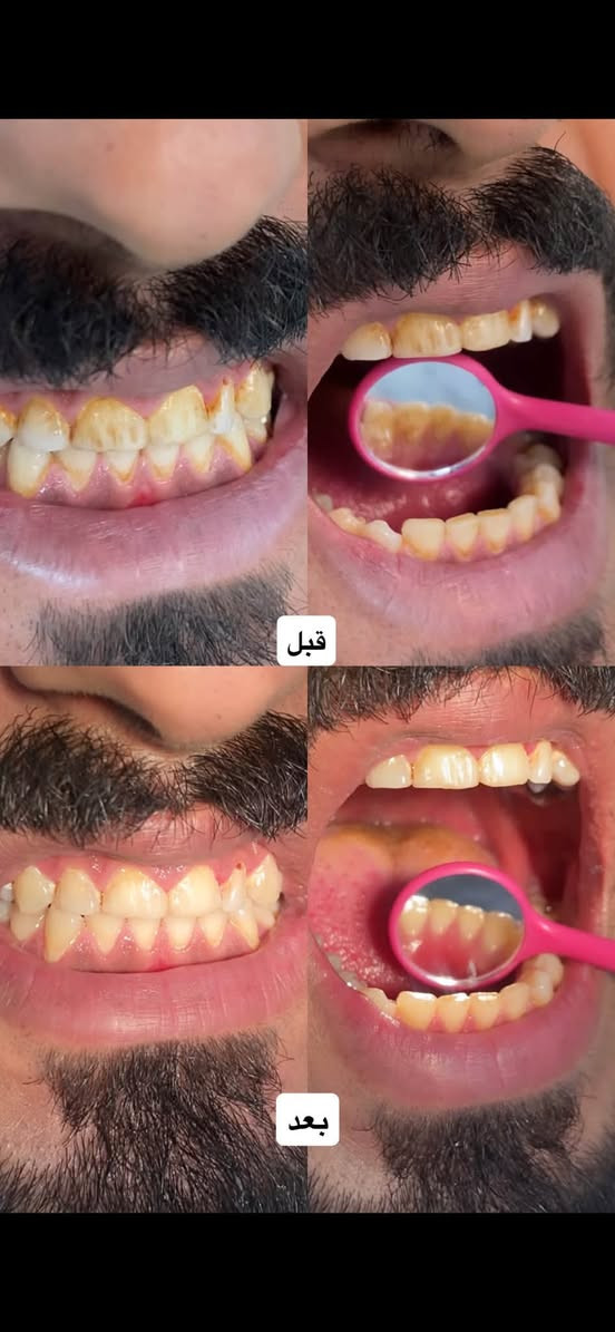 الدكتورة دانية الشمري
📍 كربلاء – عيادات جامعة الزهراوي
✨ العلاج مجاني ✨
الشغل موضح بالصور

📞 للحجز أو الاستفسار واتساب: ***********

عندك تصبغات أو تكلسات بالأسنان؟
احجز جلسة تنظيف حتى ترجع ابتسامتك المشرقة ✨

سن عقل ، سن مكسور، متآكل، أو باقي منه الجذر فقط؟
نقوم بقلع السن بكل راحة وأمان،
وبإشراف جرّاح اختصاص

تعاني من تسوّس؟
عالج السن قبل ما يوصل للجذر
 
اسنان اطفالك محتاجك علاج ؟
احجز موعدك اليوم وخلي ابتسامتك أجمل
