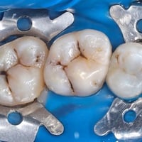 حشوات تجميلية • ثلاث أسنان • جلسة واحدة