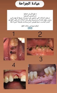 قلع أسنان • عيادة جراحة • عيادات جامعة أهل البيت
