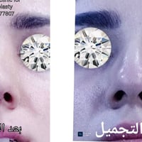 تجميل أنف • نتايج طبيعية • عيادة الياسييري