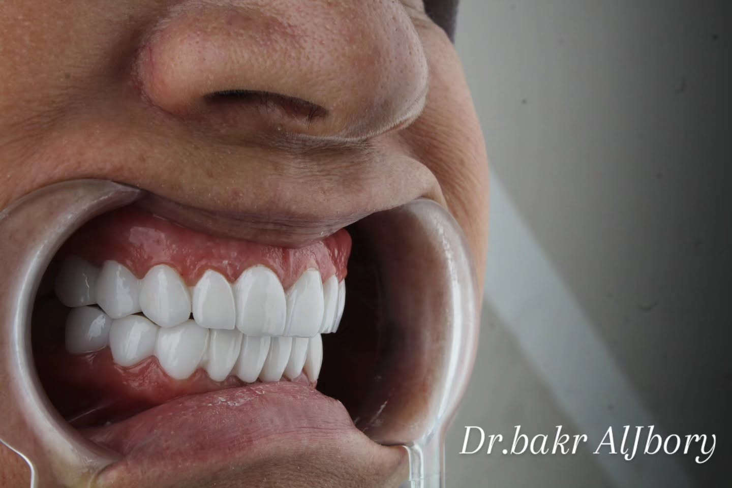 ابتسامة هوليوود • د بكر الجبوري • تجميل اسنان