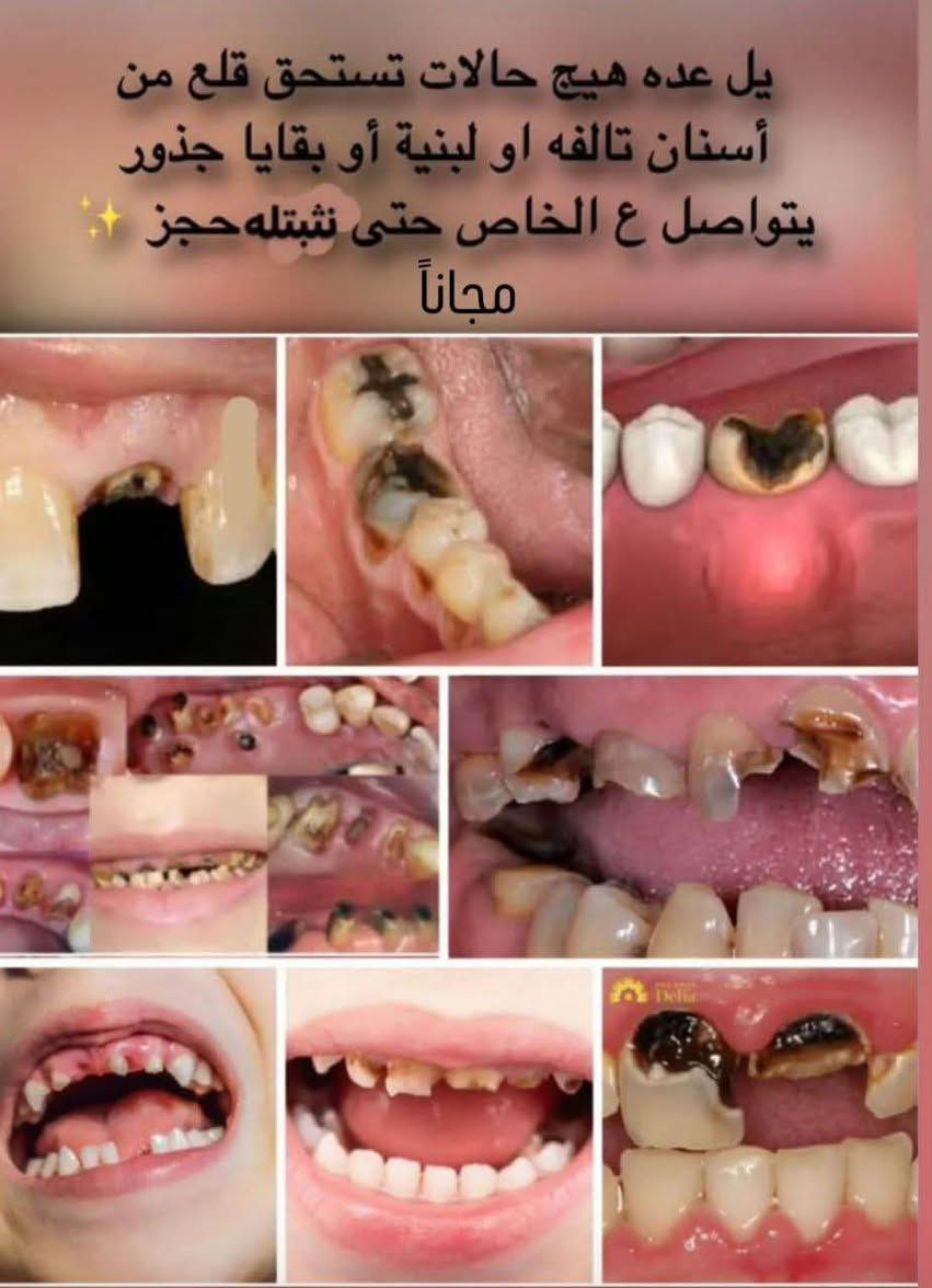 تعلن عيادات جامعة المنارة عن استقبال المرضى لإجراء العلاجات السنية مجانًا 🤍
• حشوات
• تنظيف وإزالة التكلسات
• قلع
• علاج جذور
• وغيرها من العلاجات حسب الحالة

📍 الموقع: عيادات جامعة المنارة – قرب مستشفى الصدر

📞 للاستفسار والحجز:
***********

نص مكتوب في الصور:
- اللي محتاج حشوات أمامية مثل هذه الصور يراسني العلاج مجاناً
- يل عده هيج حالات تستحق قلع من أسنان تالفه او لبنية أو بقايا جذور يتواصل ع الخاص حتى نثبتله حجز ✨ مجاناً
- طقم جزئي متحرك لشخص فاقد اسنانة نسويلة طقم مجانا 🤍🦷
- الحالات التي نستقبلها داخل العيادات علّما أن المعالجه مجانية حشوات معدنية و ضوئية قبل بعد قبل بعد قبل بعد قبل بعد
- الي عندة اسنان تالفة او جذور متبقية ويريد قلع يراسني ويكون مجاناً