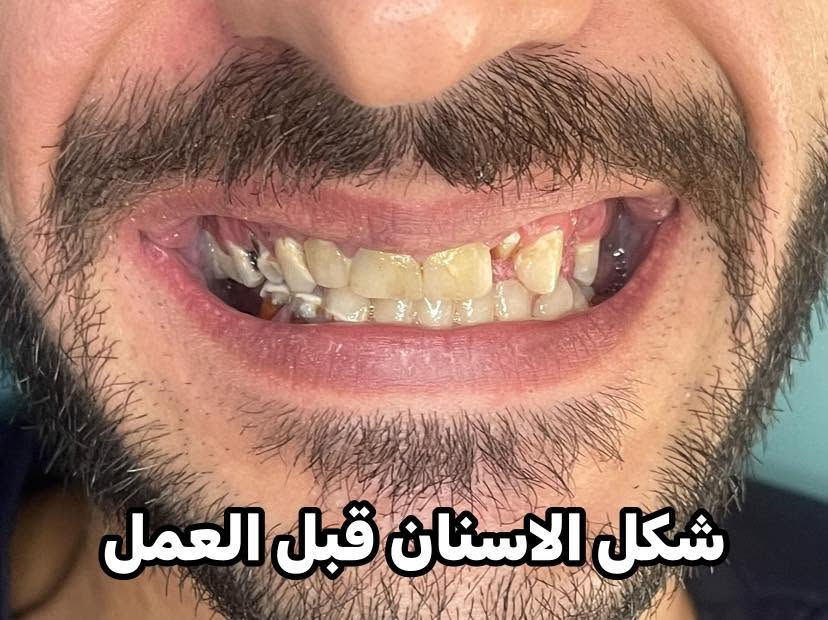 ابتسامة هوليود • زاركون ايماكس • ضمان مدى الحياة