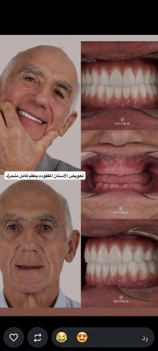 للتواصل واتساب ***********

نص مكتوب في الصور:
- تعلن كلية طب الاسنان في جامعة الهادي عن فتح عياداتها لاستقبال المراجعين لعلاج الحالات التالية:
- 1.حشوات ضوئية
- 2.قلع الاسنان التالفة وبقايا جذور الاسنان
- 3.تنظيف الاسنان وازاله التكلسات
- 4.تعويض الاسنان بتخم كامل متحرك (لكبار السن)
- 5.حشوات الجذور
- 7.عيادات خاصه ووقت خاص لاسنان الاطفال
- العنوان: الدورة/نهاية شارع 60 / مقابل كنيسة بطرس وبولص
- العلاج مجاني للاستفسار التواصل على الخاص
- nyoro.il 7 د تنظيف الاسنان من التكلسات شرط عندكم تكلسات مثل هالصوره ✨ العلاج مجاناً ✨
- اي شخص يعاني من بقايا جذور تالفه ويحتاج قلع يتواصل ويايه علمًا ان العلاج مجاناً
- تعويض الاسنان المفقوده مثل هالصوره بطقم كامل متحرك
- تعويض الاسنان المفقوده بطقم كامل متحرك