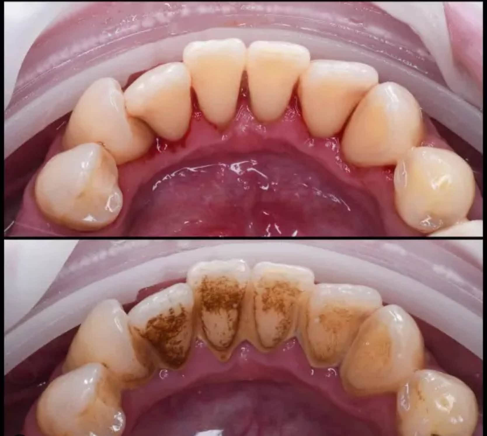 علاج مجاني الى اهالي البصرة  
حشوات تجميلية ، تنظيف الاسنان , قلع الاسنان والجذور النتبقية , تركيب طقم اسنان جزئي كل هذا مجاني تحت اشراف اطباء مختصين
للتواصل والاستفسار ***********
