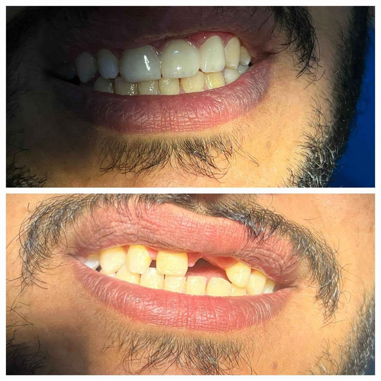 عروض الجمعه تنضيف أسنان ب20 فقط بدل 50 
الحجز على الرقم التالي ***********

نص مكتوب في الصور:
- Spudak dental group