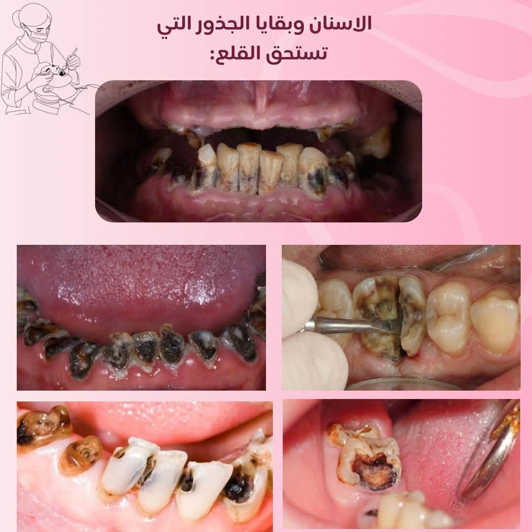اي استفسار اني حاضرة راسلوني خاص وبعيوني 🤍

نص مكتوب في الصور:
- تجنب وجع الاسنان بالكشف المبكر د/سالي محمد خدماتنا : حشوات ضوئية علاجية للأسنان المتسوسة تنظيف الأسنان وازالة التكلسات وتبييض الأسنان تعويض الأسنان المفقودة بطقم جزئي قلع الأسنان وبقايا الجذور التالفة العلاج مجاني تحت إشراف كادر أطباء مختصين العنوان : جامعة البيان - مستشفى البيان التعليمي بغداد - شارع المطار *********** Sos19m_ Soss204
- حالات التنظيف المطلوبة
- حالات التسوس :
- الحالات التي تستوجب تعويضها ب طقم جزئي متحرك :
- الاسنان وبقايا الجذور التي تستحق القلع:
