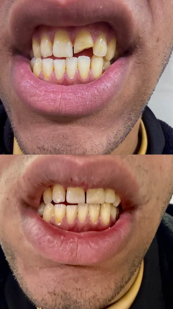 السلام عليكم
يتوفر علاج مجاني للاسنان تحت اشراف دكاترة اختصاص في عيادات جامعة اوروك طب الاسنان 
• حشوات ضوئية وتجميلية
• تنظيف وازالة التكلسات
• قلع الاسنان المتضرره والجذور المتبقية
• تنظيف وحشوات وقائية للاطفال
• اطقم اسنان كاملة لكبار السن
• جسور و تلبيسات للاسنان 
التواصل: ***********
التلگرام: @Sa3f17
الموقع: الكرادة شارع 52
