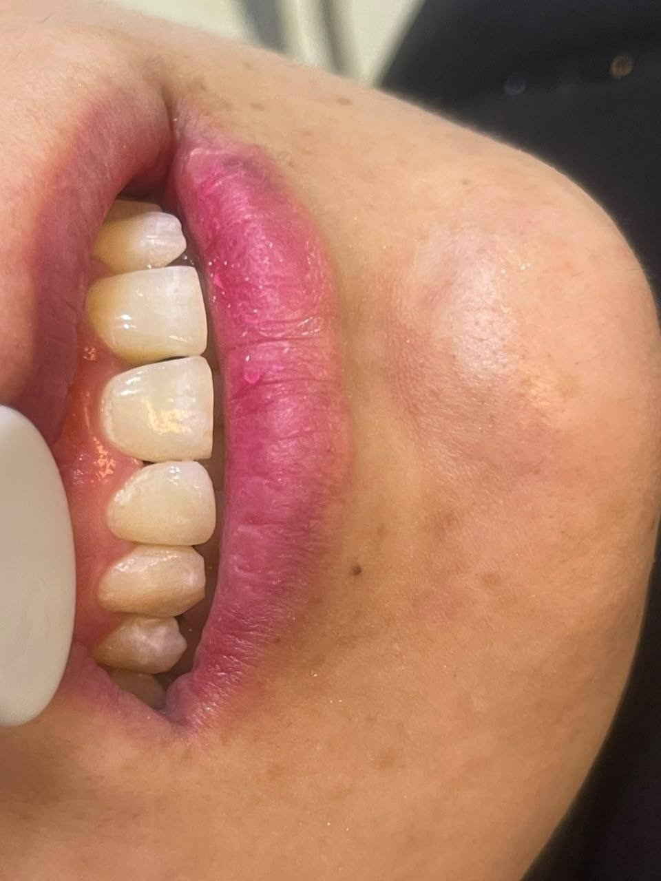 حشوة تجميلية لسن امامي مكسور بجلسة واحدة 

عيادة الماسة لطب الاسنان والتجميل 

للحجز والاستفسار 
***********

العنوان 

الرمادي ـ جويبة ـ كيتار مول قرب جامع الرسالة
