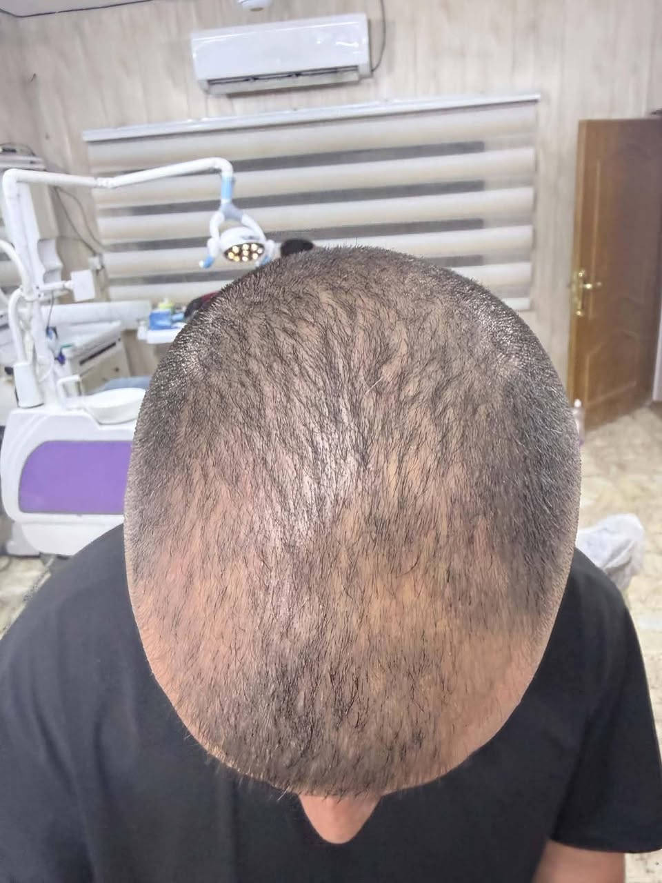 نتائج ابرة الانبات للشعر دكتورة ميسم ***********
عيادة اجنادين دكتور مؤيد محمد علي  الثعالبة الأولى شارع جامع العطاء قرب اسواق توم وجيري
