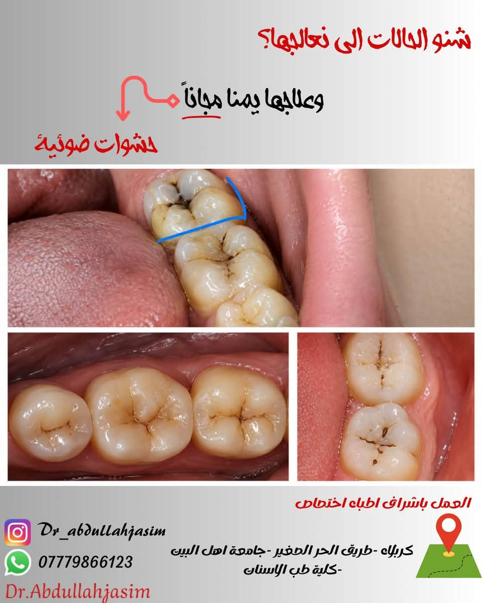 أسنانك توجعك ومأجل العلاج؟🦷✨
لا تخسر سنك ولا تشيل هم التكلفة!
احصل على علاج أسنانك مجاناً 100% وتحت إشراف أطباء
اختصاص:
حشوات ضوئية تجميلية للحفاظ على أسنانك.
• قلع الجذور والأسنان التالفة بدون ألم.
• عمل وتجهيز أطقم الأسنان المتحركة.
• كربلاء - الحر - جامعة أهل البيت / كلية طب الأسنان.
ابتسم بثقة... صحة أسنانك أمانة بيدينا

نص مكتوب في الصور:
- شنو الحالات الى نعالجها؟ وعلاجها يممنا مجاناً تعويض الاسنان المفقوده العمل باشراف اطباء اختصاص Dr_abdullahjasim *********** Dr.Abdullahjasim كربلاء -طريق الحر الصغير- جامعة اهل البيت -كلية طب الاسنان
- شنو الحالات الي نعالجها؟ وعلاجها يمناه مجاناً حشوات ضوئية العمل باشراف اطباء اختصاص كربلاء - طريق الحر الصغير - جامعة اهل البيت -كلية طب الاسنان Dr_abdullahjasim *********** Dr.Abdullahjasim
- شنو الحالات الي نعالجها؟ وعلاجها يمنا مجاناً قلع الاسنان التالفة العمل باشراف اطباء اختصاص كربلاء - طريق الحر الصغير - جامعة اهل البيت - كلية طب الاسنان Dr_abdullahjasim *********** Dr.Abdullahjasim