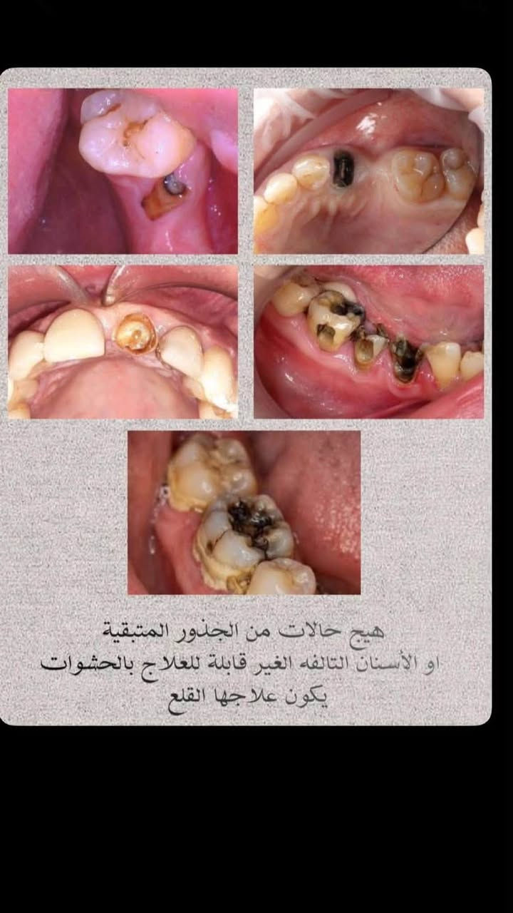 دكتورة آيات • طقم أسنان • قلع أسنان