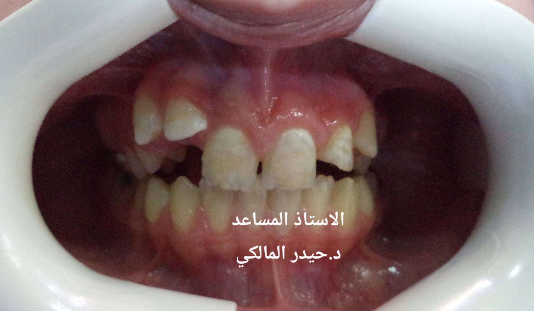 تقويم أسنان • بالتقسيط • شارع فلسطين