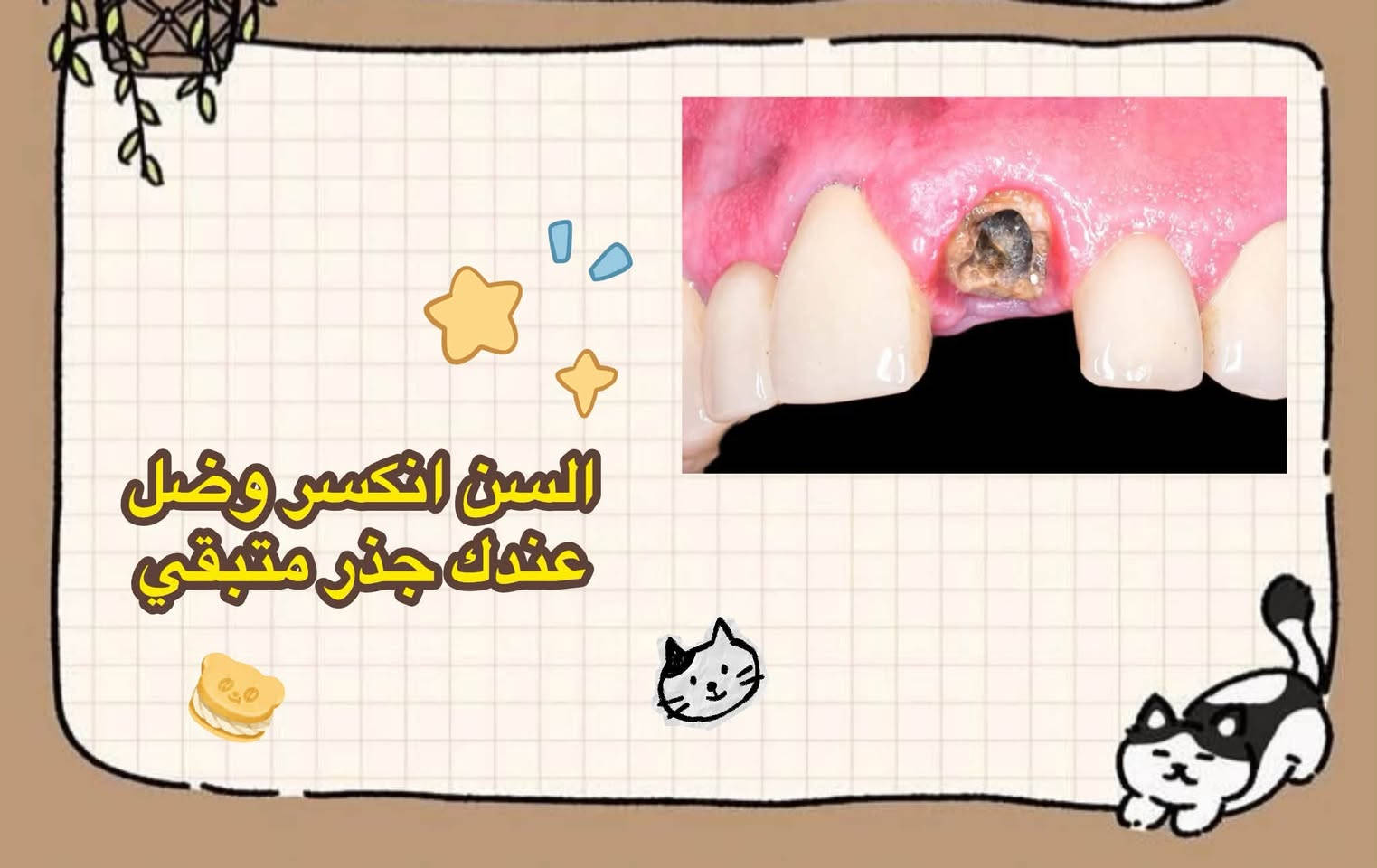 اهتموا بابتسامتكم، والبداية من صحة أسنانكم 🦷✨
تتوفر خدمات علاجية متنوعة ضمن العيادات
الجامعية، منها:
حشوات الأسنان
اقلع الجذور
ا تنظيف التكلسات ا
أطقم الأسنان
(العلاج يتم داخل العيادات الجامعية وتحت إشراف)
الكادر المختص.
للتفاصيل والاستفسار، التواصل عبر الرقم / واتساب
+964 789 158 6853
***********

نص مكتوب في الصور:
- الحالات اللي نستقبله
- التسوسات العاديه
- السن انكسر وضل عندك جذر متبقي
- قبل بعد في حال انكم فاقدين اسنان وتريدون تعوضوهن بطقم جزئي مثل هالحاله
- و تنظيف التصبغات اكيد