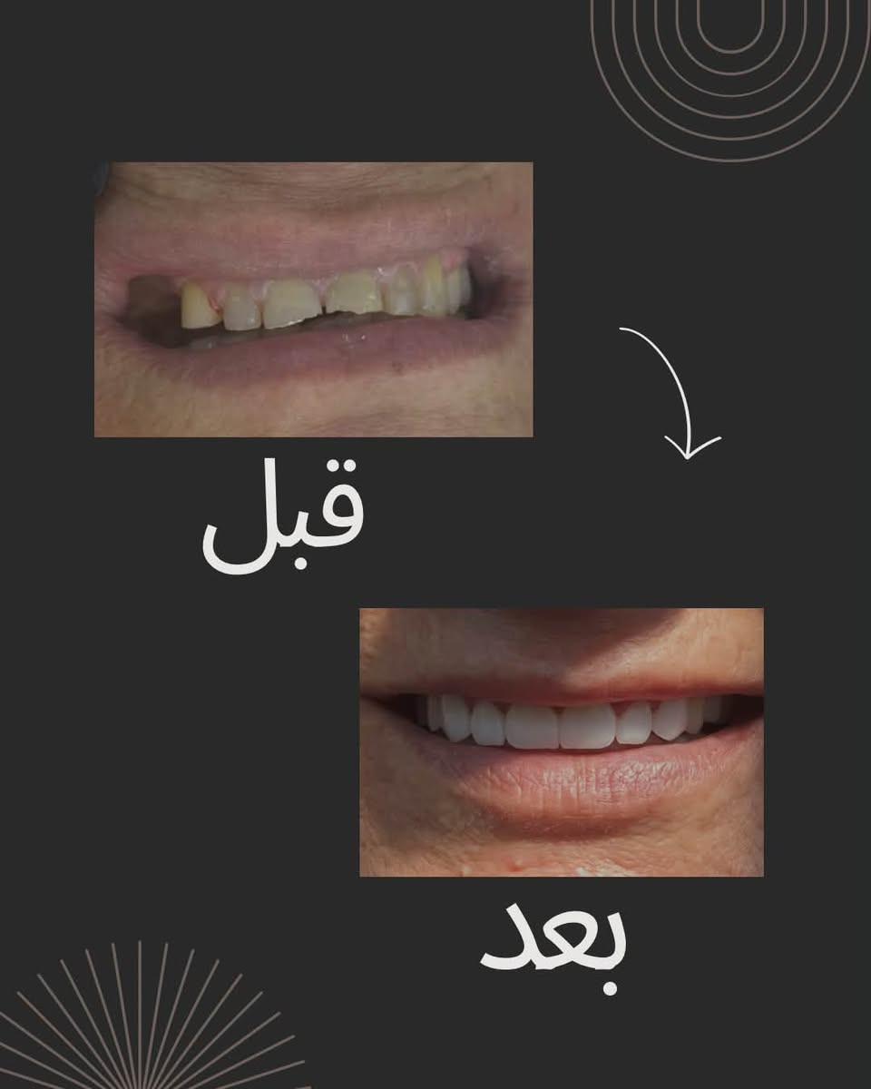 ✨ ابتسامة جديدة… وثقة أجمل 🤍

يسعدنا اليوم نشارككم نتيجة إحدى حالاتنا، حيث قمنا بإعادة تصميم الابتسامة لتكون طبيعية، متناسقة، وتعكس جمال الملامح

الدكتورة الفنانة ‪@dr.farahibrahim‬ 

📍عيادة الفهد لطب وتجميل الأسنان
 (بغداد-العبيدي-شارع ٢٠ - قرب مدرسة سما بلادي الاهلية - الطابق الاول )
📞 ***********
📞 ***********
.
.
.
.
.
.
.
#عيادة_الفهد #ابتسامة٠هوليود #حشوة_جذر #عيادةأسنان #ابتسامه #اكسبلور #المشتل # #فولو #لايكات #فايرل #اسنان
