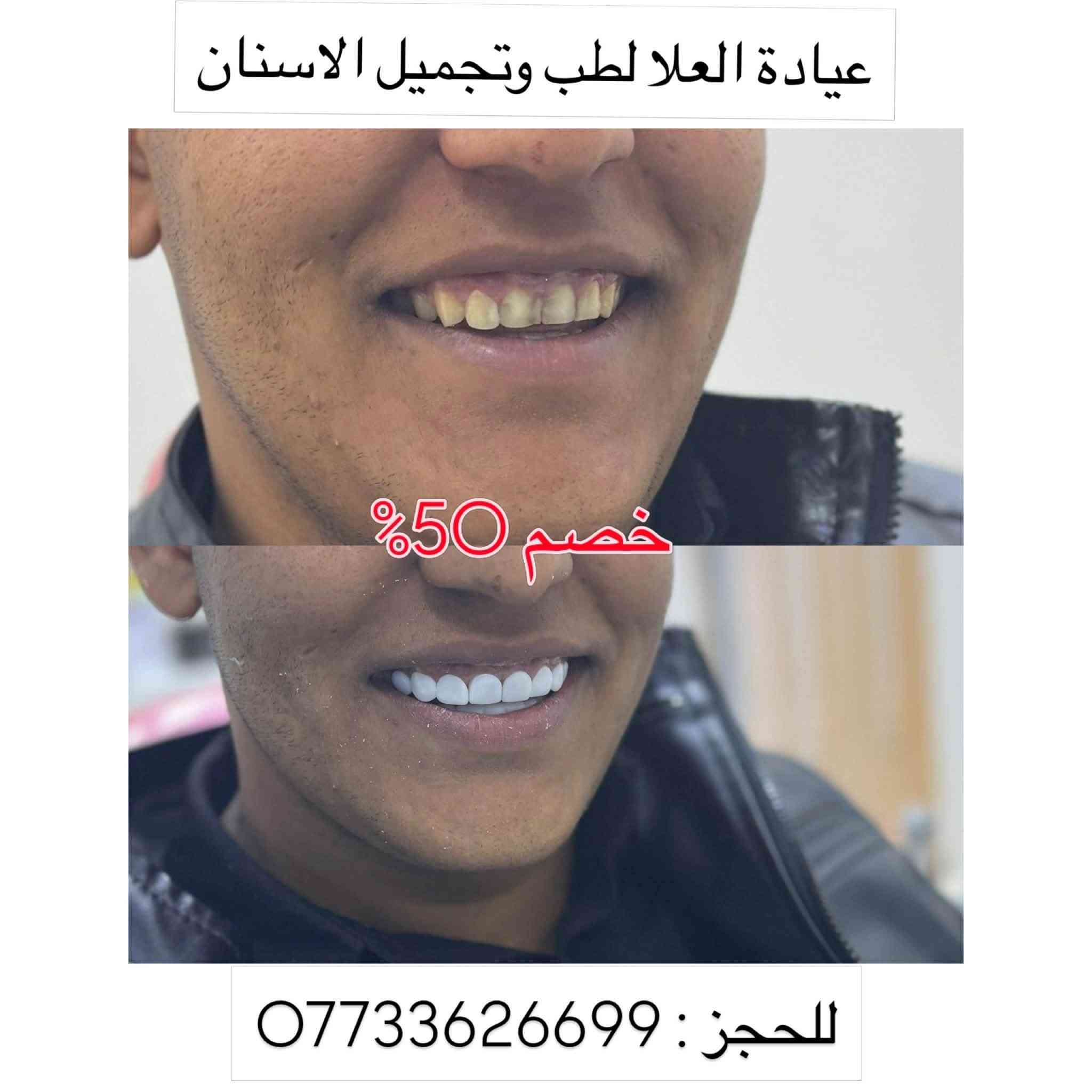 خصم ٥٠٪ • ابتسامة هوليوود • الشرطة الخامسة
