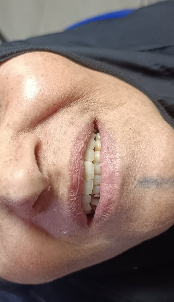 ✨ ابتسامة وثقة 🩵

عيادات الفرح لطب وتجميل الأسنان – فرع حي النصر 🦷

تعويض الأسنان فك اعلى  بأسنان( التيتانيوم  الألماني) وابتسامة جميلة للحاجة ام علاء من اهالي حي النصر 

🦷 ابتسامتك ويّا عيادات الفرح غير
🛡️ ضمان مدى الحياة

📍 العنوان:
حي النصر / شارع السوق / خلف جامع الإمام المهدي
فوق صيدلية مصطفى جاسم أو أسواق الزعيم

📞 ***********

⏰ الدوام: من 4 عصراً إلى 9 مساءً
