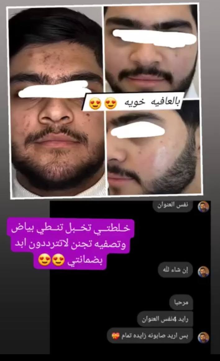 #الف رحمه على روح امه وابوه اليعلقلي هذا باب رزقي الوحيد #يارزاق ❤️
خلطة بشرة تجنن تسوي الوجه گيمر 
طبعا تستخدم للرجال ونساء 

#خلطه عباره عن كولاجين وفيتامينات  شغلها يخبل  وفوائده تجنن على بشره 

اي أضرار جانبية مابيها

تبيض  تصفيه   للكلف  للنمش  أثار حب شباب        

نتائجها  بعد  الاسبوع  الاول
 
خلطة + صابونه طبيه

للحجز مراسله الخاص او عالواتساب ***********
