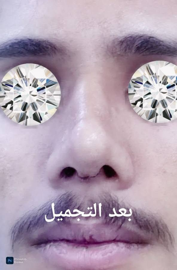 تجميل الانف • طبيعي • قبل وبعد