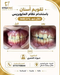 ✨ ابتسامة أجمل تبدأ بخطوة بسيطة! مع نظام مايوبريس (Myobrace)، نساعد عل...