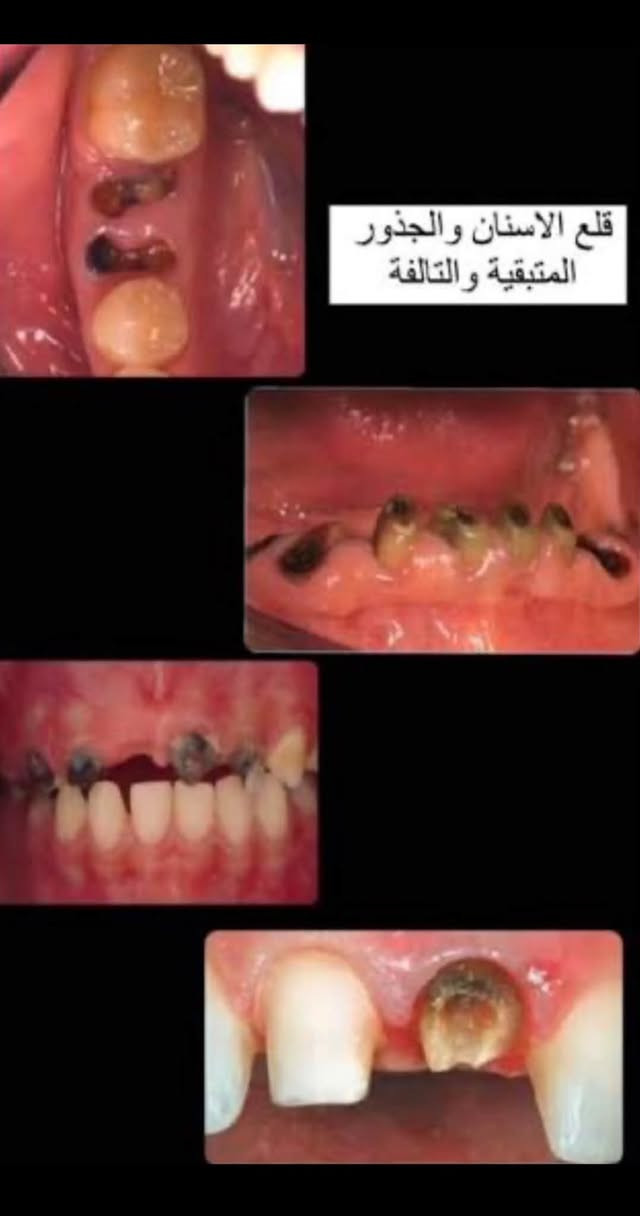 العلاج مجاني
العنوان : عيادات جامعة ابن سينا للعلوم الطبية و الصيدلانية مقابل محطة وقود البياع 
حشوات ضوئية و قلع الاسنان و تنظيف ( ازالة التكلسات ) 
تعويض الاسنان المفقودة بشكل كامل ( طقم أسنان متحرك ) و متوفر علاج للاطفال حشوات و قلع و تقويم 
الرقم : *********** 
التواصل : واتساب

نص مكتوب في الصور:
- قلع الاسنان والجذور المتبقية والتالفة