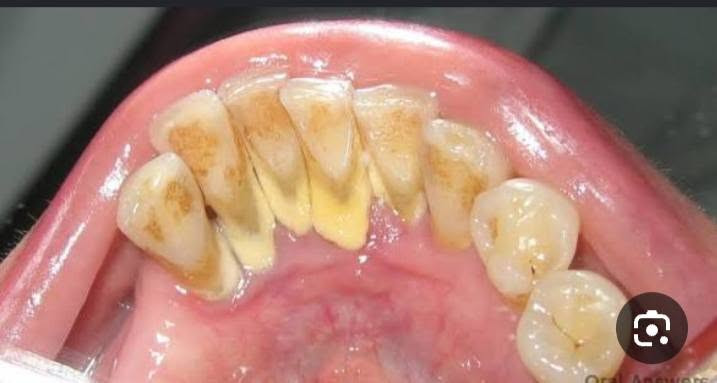 تكلسات • ضعف بصر • حجز موعد