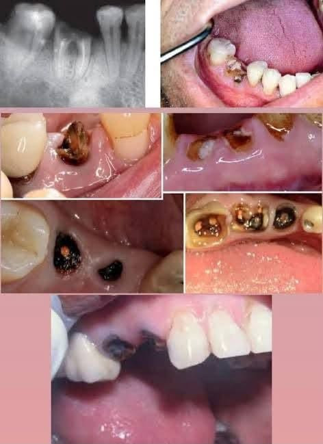 حشوات تجميلية • تنظيف أسنان • شبه مجانية
